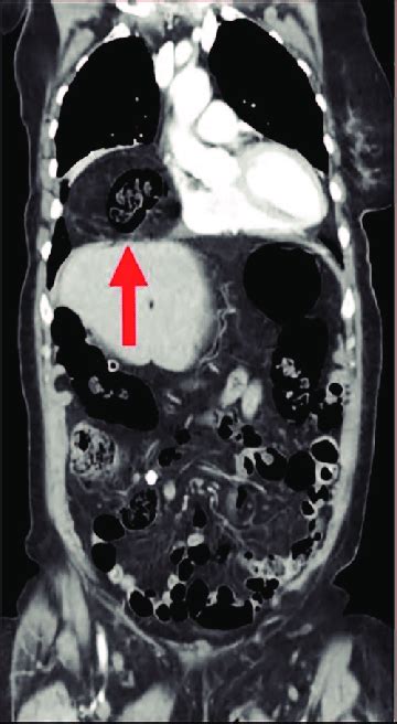A Ct Chest Abdomen And Pelvis With Po And Iv Contrast In 2017 Shows