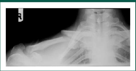 Figure 1 From Subacromial Supracoracoid Dislocation Of The