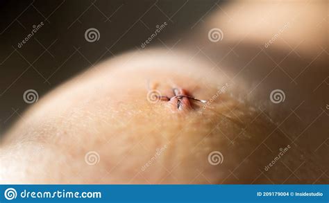 Close Up Of A Surgical Suture After Laparoscopic Meniscus Surgery