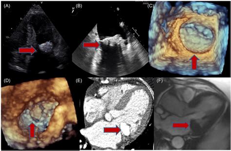 Multimodality Imaging Of The Caseous Calcification Of The Mitral