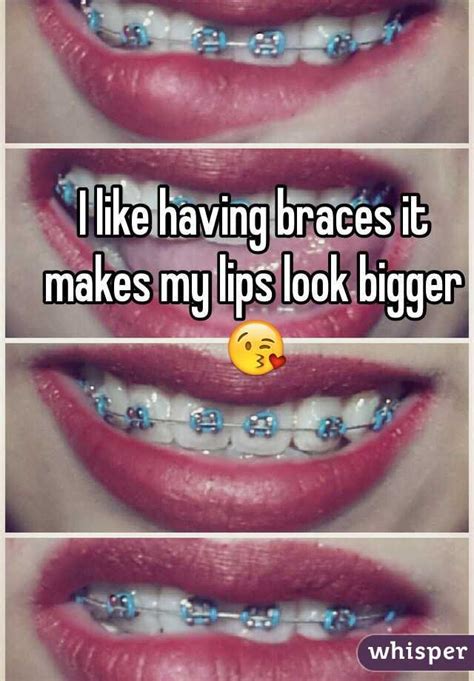 Do Your Lips Look Bigger With Braces