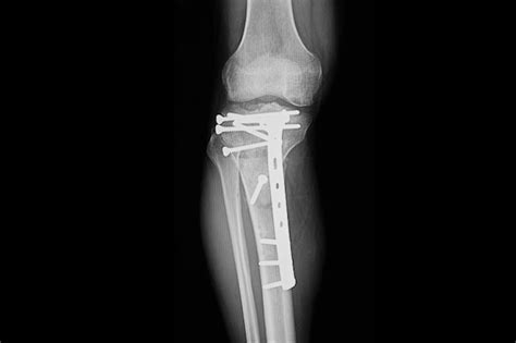 Premium Photo Fractured Proximal Tibia With Plate And Nails Fixation