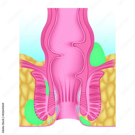 Anorectal Abscess Swelling Near The Anus Inflammation Of The Anus And Rectum Disease Of The