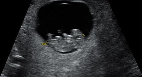 Ultrasound Direct Dating Scan