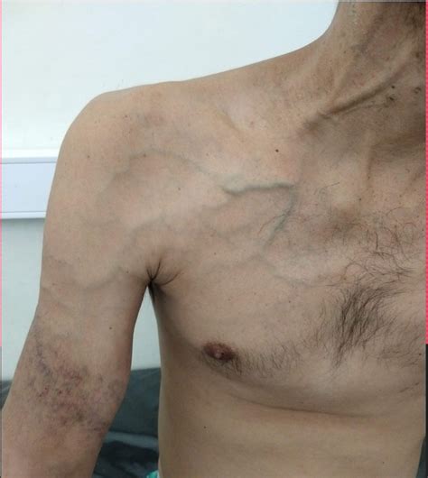 List 92 Images Blue Veins On Chest And Shoulders Male Sharp