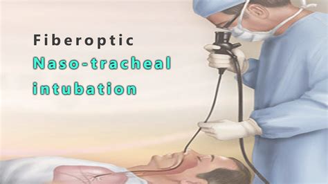 Fiberoptic Nasotracheal Intubation Youtube