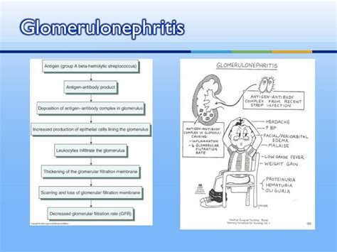 Ppt Glomerulopathies Vs Glomerulonephritis Powerpoint Presentation