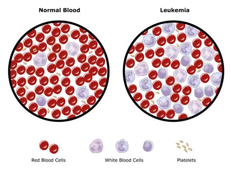 Leukemia Orthoinfo Aaos