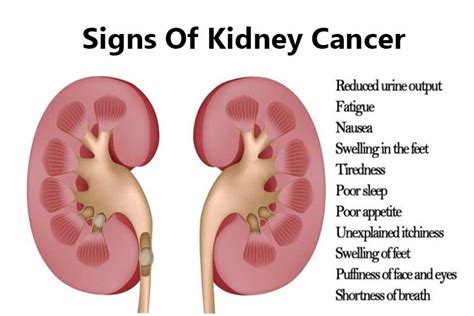 Kidney Cancer Swelling Kidney Failure Disease