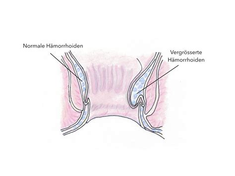 Als ursachen für hämorrhoiden werden ein ungesunder lebensstil, pressen beim stuhlgang sowie genetische faktoren genannt. Hämorrhoiden