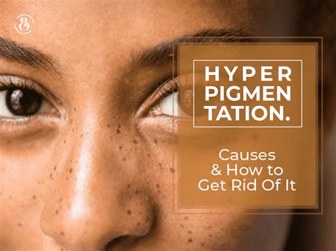 Hyperpigmentation Causes And How To Get Rid Of It Beaucrest