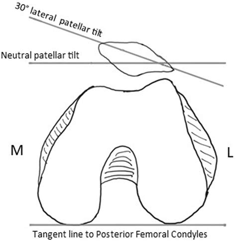 Lateral Patellar Retinaculum Z Lengthening Arthroscopy Techniques