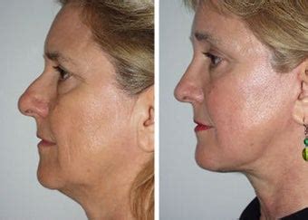 Less often, a sore nose can be caused by issues. Rhinoplasty removal of bump on nose photo from William ...