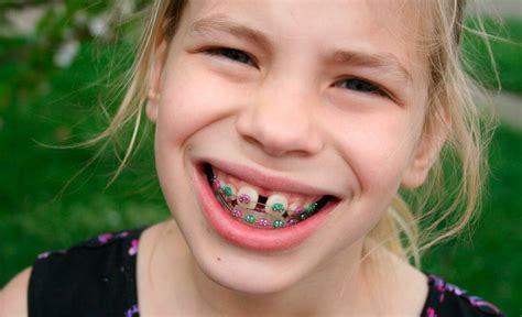 How Long Do Braces Take To Close A Gap In India