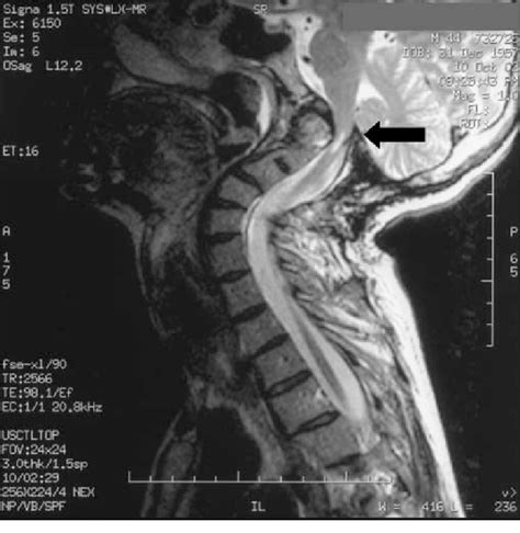 Sagittal T2 Weighted Mri Of The Skull Base And Cervical Spine