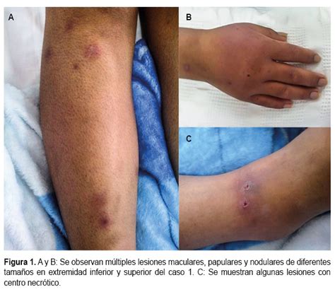 Fusariosis Invasiva Reporte De Tres Casos En Perú