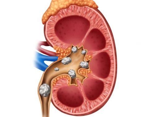 Complications that can arise with stones (a kidney infection that develops behind an. Kidney stone treatment complications common in 14 percent ...