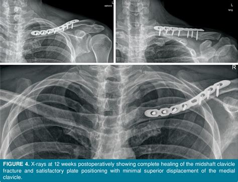 Figure 4 From Surgical Treatment Of Anterior Sternoclavicular