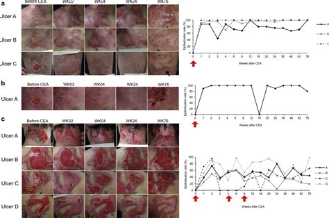Cultured Epidermal Autografts From Clinically Revertant Skin As A