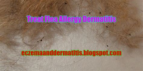 Treat Flea Allergy Dermatitis Eczema And Dermatitis
