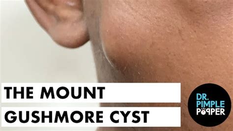 A Rubber Ball Cyst In The Cheek Cystactular Cysts Dr Pimple Popper