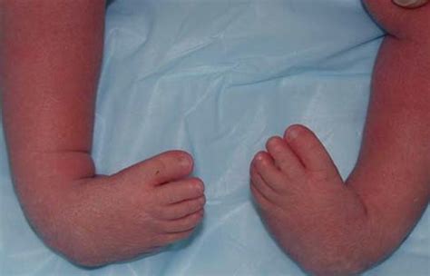 Club foot (also called talipes) is where a baby is born with a foot or feet that turn in and under. Club Foot - Pictures, Symptoms, Causes, Treatment