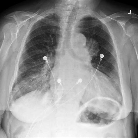Aortic Dissection Aortic Dissection Chest X Ray Image
