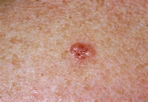 Close Up Showing A Basal Cell Carcinoma Stock Image M1310169