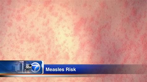 Cook County Under High Risk For Measles Outbreak Due To International