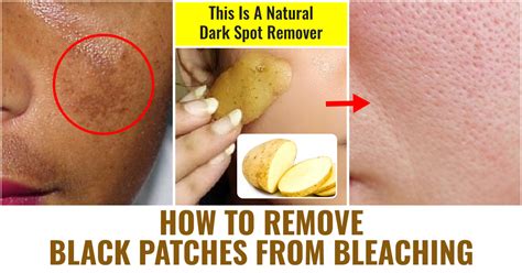 How To Remove Black Patches From Bleaching