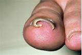 Pictures of Foot Doctor To Remove Ingrown Toenail