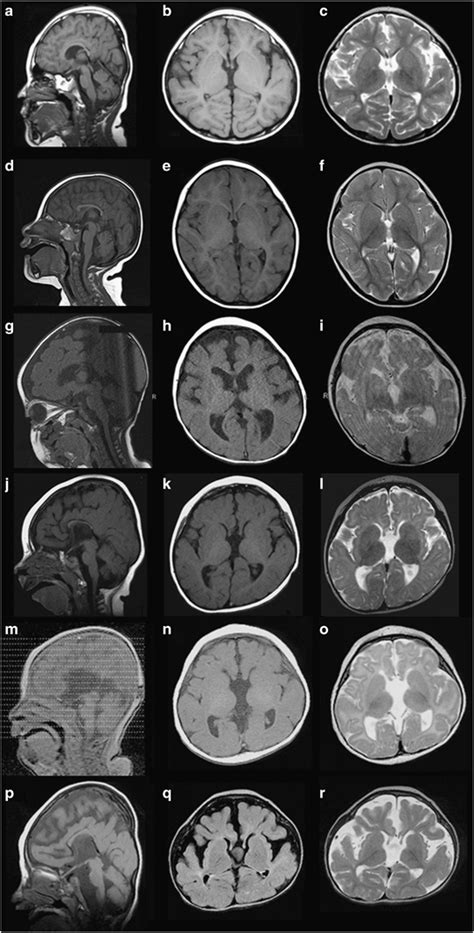 The Brain Mri Findings Of Patient 1 Examined At 4 Years Ac Patient
