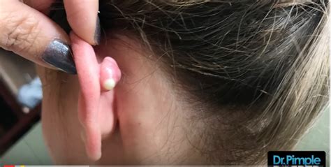 Watch Dr Pimple Popper Blast This Massive Growth Behind Womans Ear Video John Hawkins