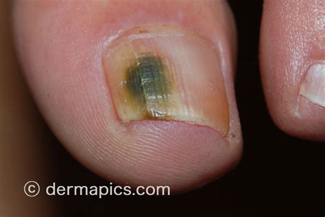 The Different Types Of Fungal Nail Infection And How They Present