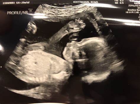 20 Weeks Ultrasound Pictures