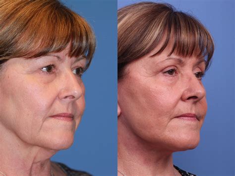 Facelift Before And After Pictures Case 214 Scottsdale Az Hobgood Facial Plastic Surgery