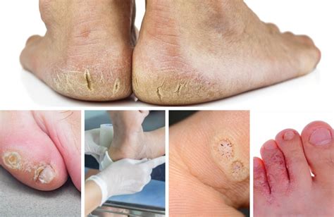 5 Skin Conditions Podiatrists Treat Advance Foot Clinic Podiatry
