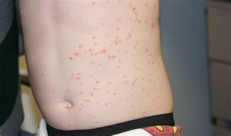 Molluscum Contagiosum A Common Viral Skin Condition In Children