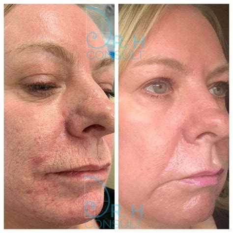 Laser Skin Resurfacing London Surrey Dr H Consult