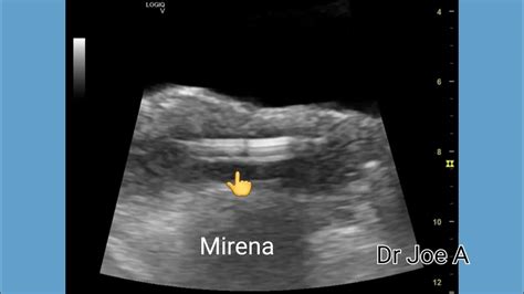 Mirena Iud Vs Copper T Iud Iucd Comparison On Ultrasound Imaging Youtube