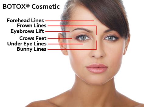 We did not find results for: botox_diagram | Botox cosmetic, Botox, Eyebrow lift