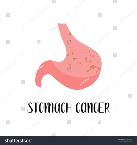 Stomach Cancer Gastric Carcinoma Oncology Gastric Stock Vector Royalty