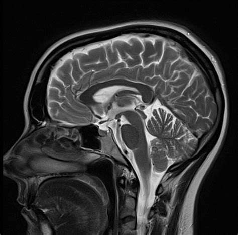Brain Mri T2 Sagittal Images