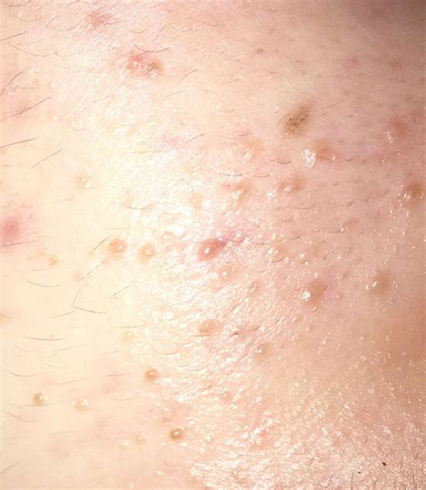 White Bump On Skin Cancer