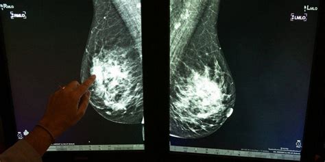 Breast Cancer Faq 8 Things You Should Know About Getting Your First Mammogram Daily Sabah