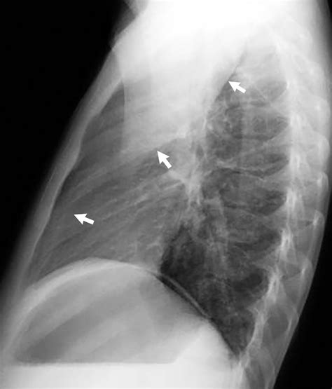 Atelectasis Vs Pneumonia Chest X Ray
