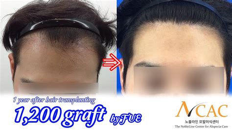 2700 grafts norwood 3 pattern. FUE Hair transplant for asian_Nobleline asian hair ...
