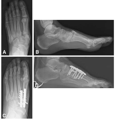 A2d A Ap And B Lateral Radiographs Are Shown For A Patient With A Download Scientific