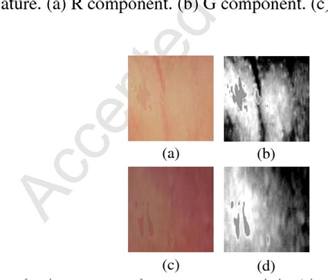 Figure 7 From Examining Palpebral Conjunctiva For Anemia Assessment
