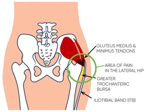 Could My Hip Pain Be Gluteal Tendinopathy Central Coast Spinal Care